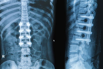 Minimally Invasive Spine Surgery